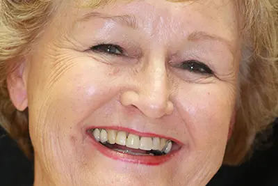 Full Mouth Implants - Case Study from Implant & Periodontics Solutions in Sun City West, AZ