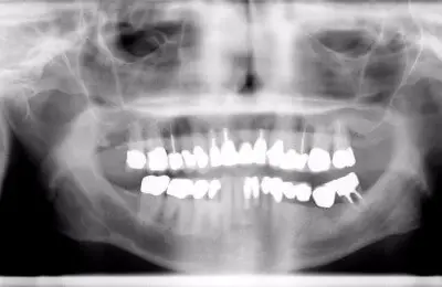 X-Ray of a patient's jaw from Implant & Periodontics Solutions in Sun City West, AZ