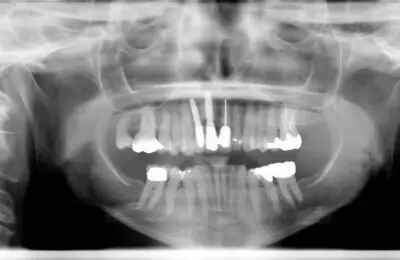 X-ray of patient's jaw and teeth from Implant & Periodontics Solutions in Sun City West, AZ