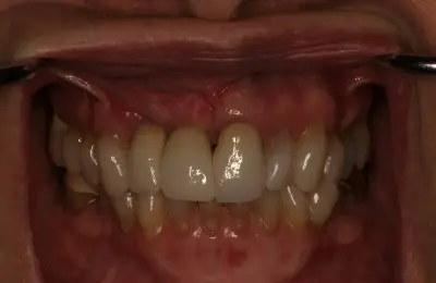 Close up of patient's teeth from Implant & Periodontics Solutions in Sun City West, AZ