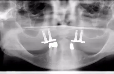 X-Ray of a patient's jaw from Implant & Periodontics Solutions in Sun City West, AZ