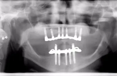 X-Ray of patient's jaw from Implant & Periodontics Solutions in Sun City West, AZ