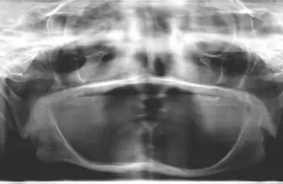 Patient's X-Ray from Implant & Periodontics Solutions in Sun City West, AZ