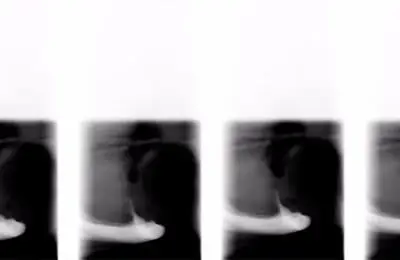 Patient's X-Ray from Implant & Periodontics Solutions in Sun City West, AZ