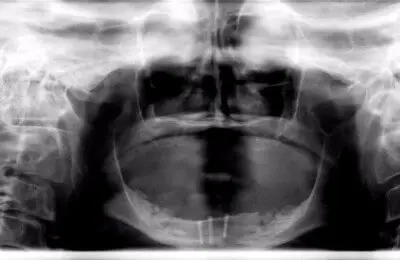 Patient's X-Ray from Implant & Periodontics Solutions in Sun City West, AZ