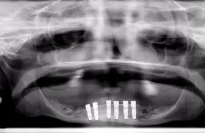 Patient's X-Ray from Implant & Periodontics Solutions in Sun City West, AZ