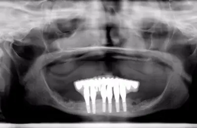 Patient's X-Ray from Implant & Periodontics Solutions in Sun City West, AZ