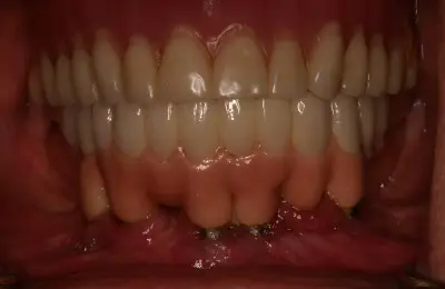 Close up of patient's teeth and gums from Implant & Periodontics Solutions in Sun City West, AZ