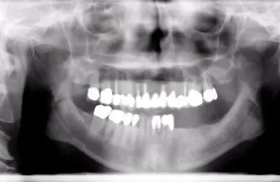X-Ray of a patient's jaw from Implant & Periodontics Solutions in Sun City West, AZ