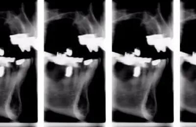Dental X-Rays from Implant & Periodontics Solutions in Sun City West, AZ