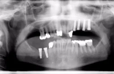 X-Ray of patient's teeth with implant posts from Implant & Periodontics Solutions in Sun City West, AZ