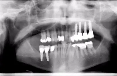 X-ray of patient's jaw and teeth with implants from Implant & Periodontics Solutions in Sun City West, AZ