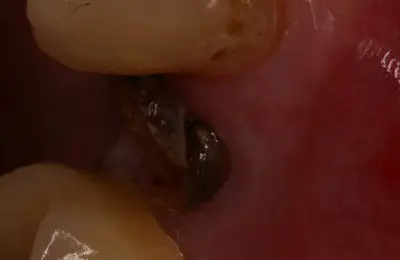 Close up of patient's teeth with missing tooth from Implant & Periodontics Solutions in Sun City West, AZ