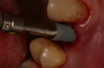 Close up of patient's teeth with implant post from Implant & Periodontics Solutions in Sun City West, AZ