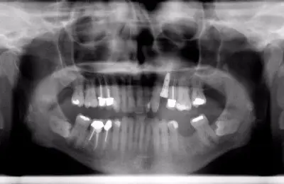 X-ray of patient's jaw and teeth with implants from Implant & Periodontics Solutions in Sun City West, AZ