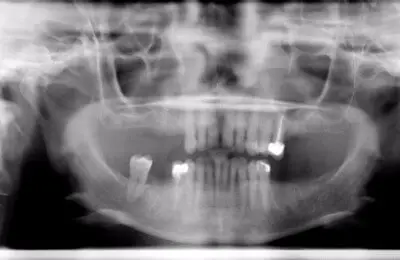 X-Ray of patient's teeth from Implant & Periodontics Solutions in Sun City West, AZ