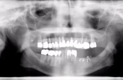 X-Ray of jaw and teeth from Implant & Periodontics Solutions in Sun City West, AZ