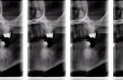 Dental X-Rays from Implant & Periodontics Solutions in Sun City West, AZ