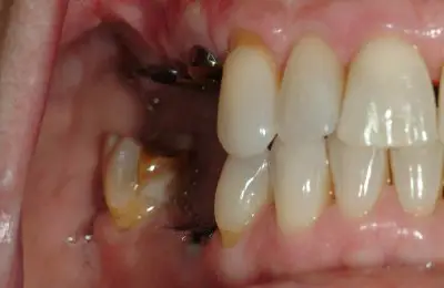 Close up of patient's teeth with missing teeth from Implant & Periodontics Solutions in Sun City West, AZ