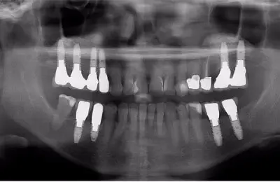 X-ray of patient's jaw and teeth with implants from Implant & Periodontics Solutions in Sun City West, AZ