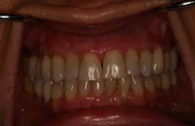 Close up of patient's teeth from Implant & Periodontics Solutions in Sun City West, AZ