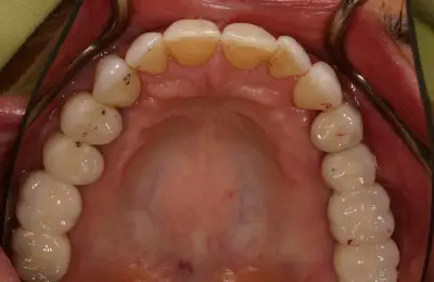 Close up of patient's lower teeth from Implant & Periodontics Solutions in Sun City West, AZ