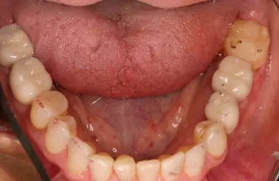 Close up of patient's teeth from Implant & Periodontics Solutions in Sun City West, AZ