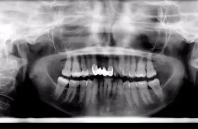 X-Ray of patient's teeth from Implant & Periodontics Solutions in Sun City West, AZ