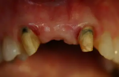 Close up of patient's teeth with missing teeth from Implant & Periodontics Solutions in Sun City West, AZ