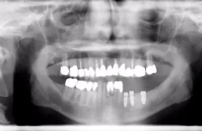 X-ray of patient's jaw and teeth from Implant & Periodontics Solutions in Sun City West, AZ