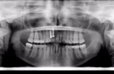 X-ray of patient's jaw and teeth with implants from Implant & Periodontics Solutions in Sun City West, AZ