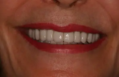 Close up of patient's smile and teeth from Implant & Periodontics Solutions in Sun City West, AZ