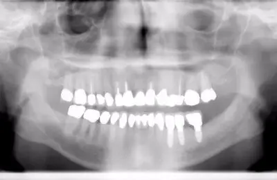 X-ray of patient's jaw and teeth from Implant & Periodontics Solutions in Sun City West, AZ