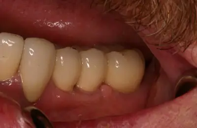 Close up of patient's teeth from Implant & Periodontics Solutions in Sun City West, AZ