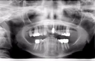 X-Ray of a patient's jaw from Implant & Periodontics Solutions in Sun City West, AZ
