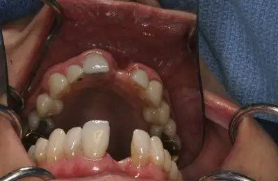 Close up of a patient's teeth from Implant & Periodontics Solutions in Sun City West, AZ