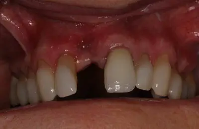 Close up of patient's teeth with missing tooth from Implant & Periodontics Solutions in Sun City West, AZ