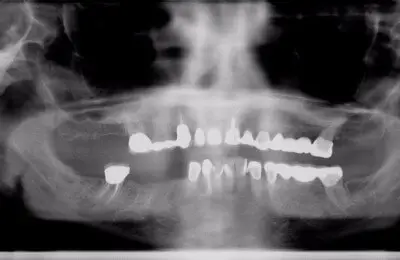 X-Ray of a patient's jaw from Implant & Periodontics Solutions in Sun City West, AZ
