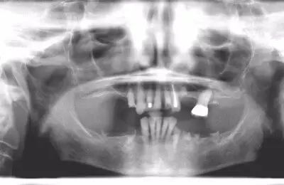 X-Ray of dental implants from Implant & Periodontics Solutions in Sun City West, AZ