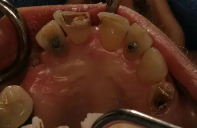 Close up of lower jaw from Implant & Periodontics Solutions in Sun City West, AZ
