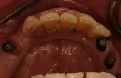 Close up of teeth at Implant & Periodontics Solutions in Sun City West, AZ