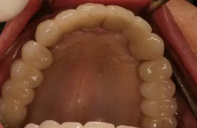 Close up of lower teeth from Implant & Periodontics Solutions in Sun City West, AZ