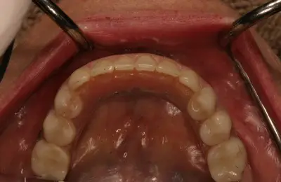Close up of teeth from Implant & Periodontics Solutions in Sun City West, AZ