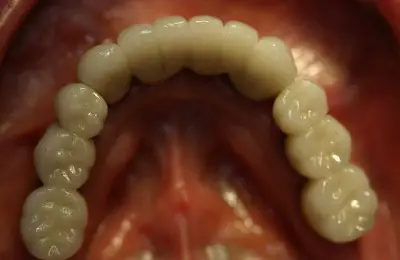 Close up of lower teeth at Implant & Periodontics Solutions in Sun City West, AZ