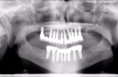 X-Ray of jaw and teeth from Implant & Periodontics Solutions in Sun City West, AZ