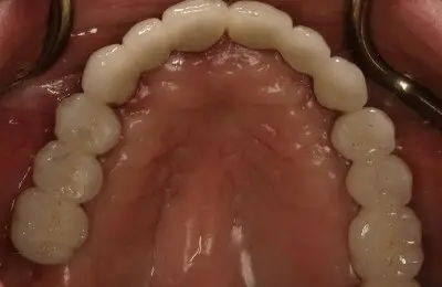 Close up of patient's lower teeth from Implant & Periodontics Solutions in Sun City West, AZ
