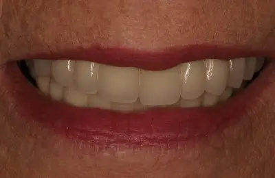 Close up of smiling mouth with teeth from Implant & Periodontics Solutions in Sun City West, AZ