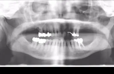 X-Ray of teeth at Implant & Periodontics Solutions in Sun City West, AZ