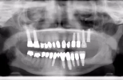 X-Ray of dental implants from Implant & Periodontics Solutions in Sun City West, AZ