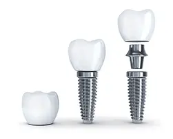 Rendering of dental implants with posts